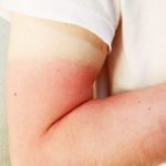 ニキビができている肌に日焼けは厳禁!ニキビを悪化させることも!