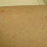 二の腕のニキビはなにが原因?必要な対処法はなに?