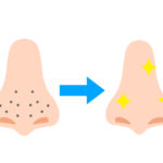 毛穴の状態でニキビができる!肌質別の毛穴が開く原因と詰まる原因とは?
