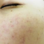 ニキビ跡の赤みを消す方法ってなに?スキンケアから食事・生活習慣まで